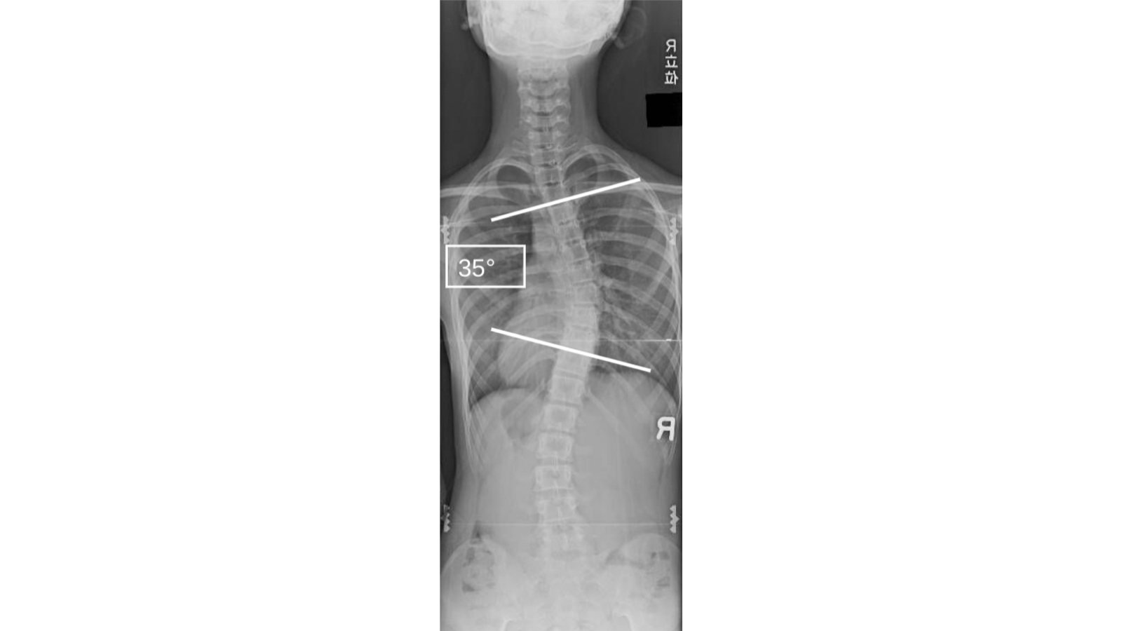 思春期特発性側弯症の症例の背部から撮像したレントゲン（10歳台 女性 コブ角35度の中等症）