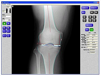イノテックが提供する変形性膝関節症診断支援ソフト「KOACAD」。健康に大きな影響を与え、その予備軍が2500万人と推定される変形性膝関節症を全自動で診断する支援ソフトで、東京大学と共に開発したという。