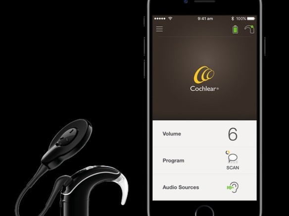 「iPhone」から聴覚神経に音を伝える蝸牛インプラント「Nucleus 7」