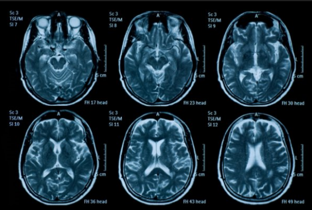 脳機能マッピング

　脳機能を部位ごとに解明しようとするマッピング技術は、精神疾患の治療を支援することにより、2013年ごろより寿命の延長に貢献するようになったと推測される。年間約400万人の命を救っている（Aperion Care）。