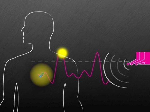 MIT、体内の医療デバイスへワイヤレス給電する技術--バッテリ搭載が不要に