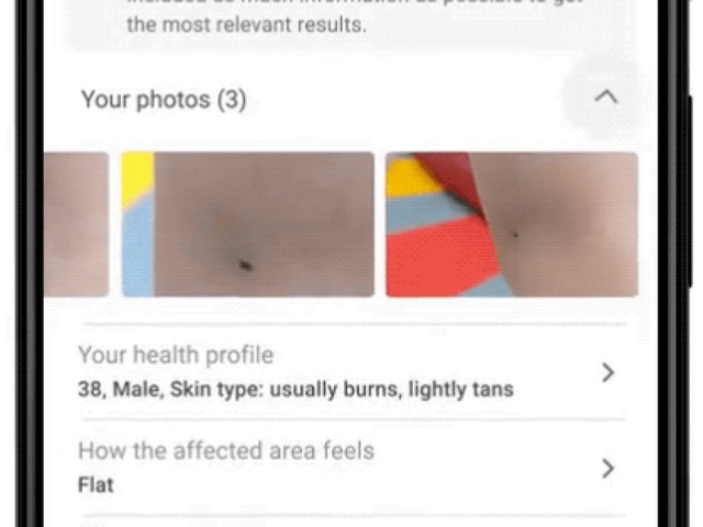 グーグルのAI、患部の写真から皮膚病の判定を支援