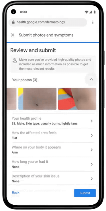 Googleの皮膚病判定支援ツール