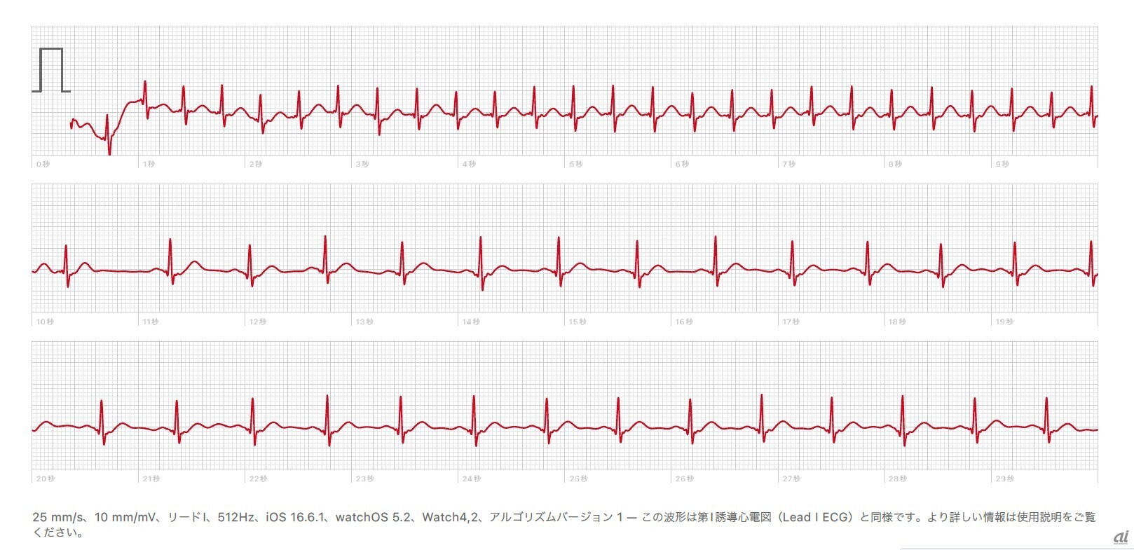 飯村氏のApple Watchで記録された、上室性頻拍の心電図。心拍数が200回／分ぐらいまで早かったところ（上段）から、100以下に落ちたところが記録されている