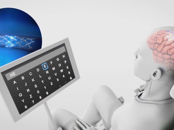 脳インプラントによる会話をOpenAIの生成AIで支援、米Synchronの挑戦