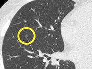 「ステージ0の肺がんを尿検査で検出→完治に成功」との研究結果–日本のスタートアップら
