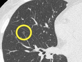 「ステージ0の肺がんを尿検査で検出→完治に成功」との研究結果--日本のスタートアップら