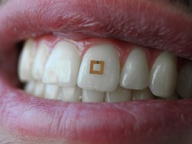  歯に貼り付ける2mm角の超小型センサ--食べ物の栄養素データを無線送信